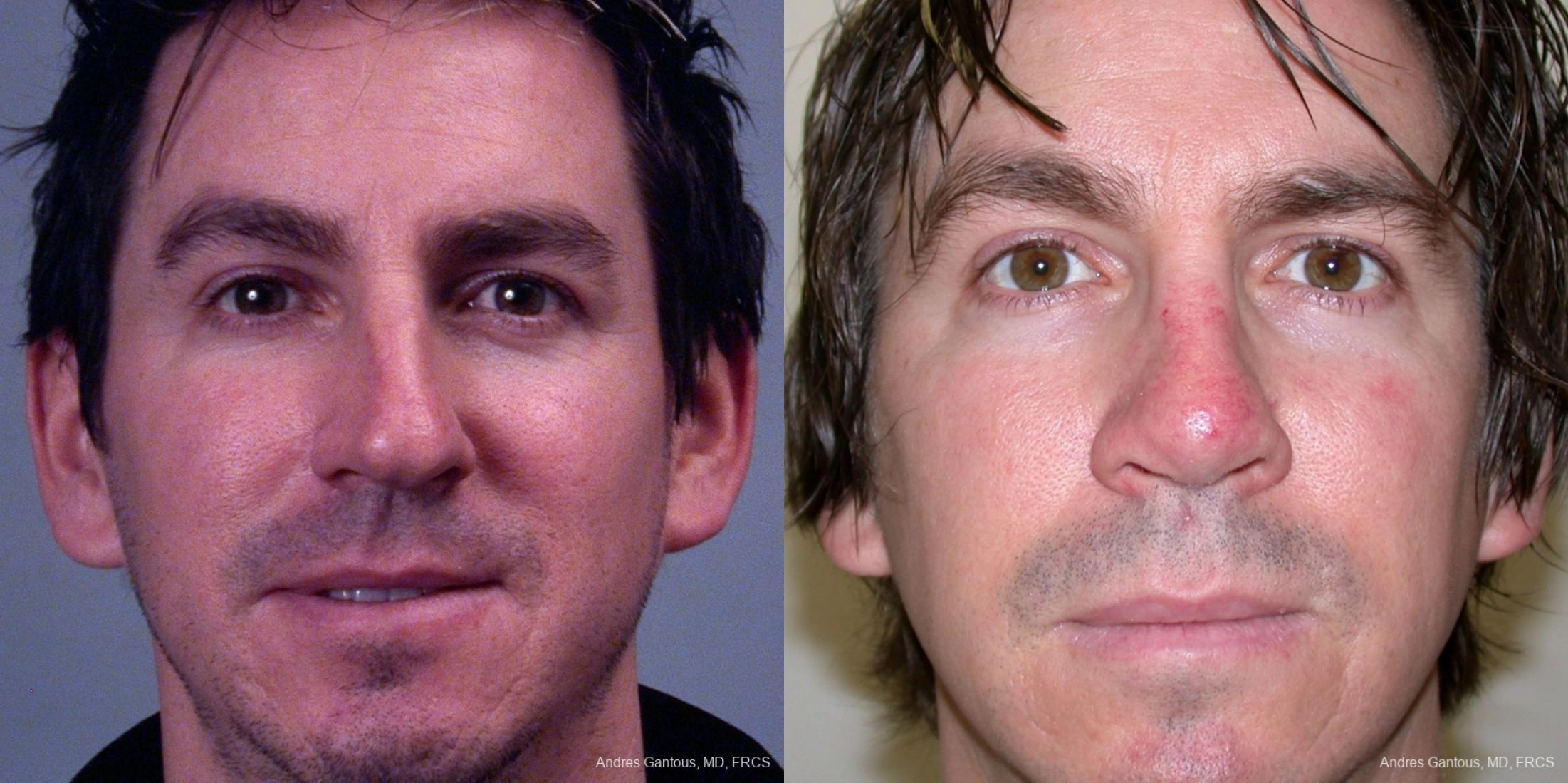 Nose Procedures - Case 11628