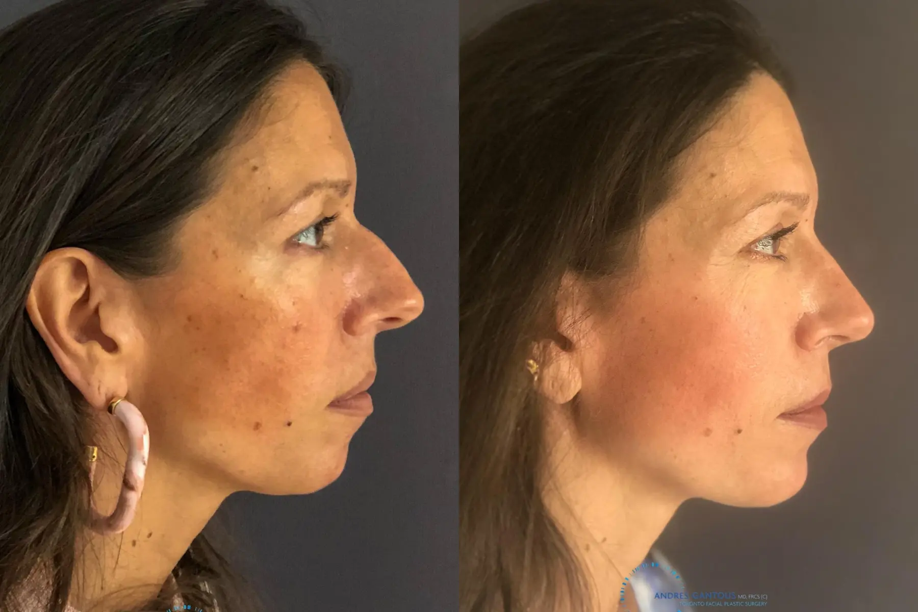 Rhinoplasty: Patient 8 - Before and After 4