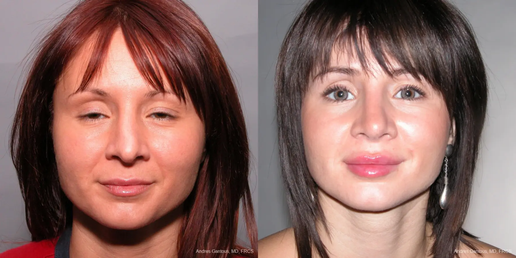 Rhinoplasty: Patient 36 - Before and After 1