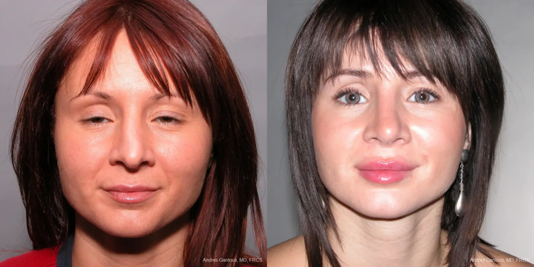 Rhinoplasty: Patient 36 - Before and After  