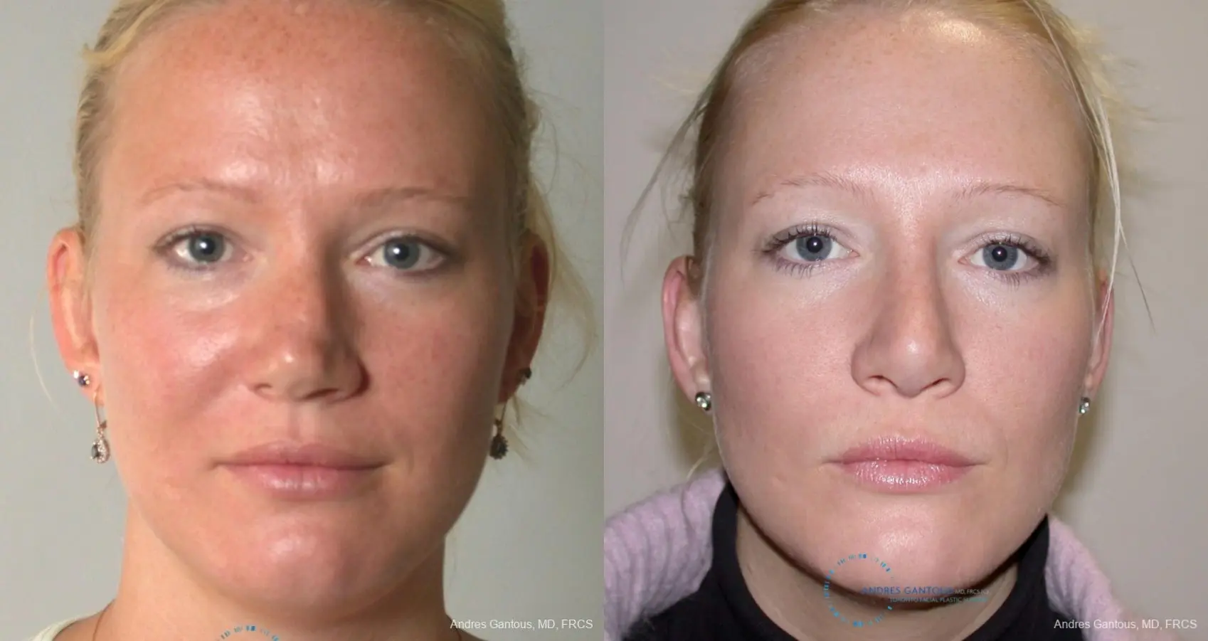 Rhinoplasty: Patient 92 - Before and After 1