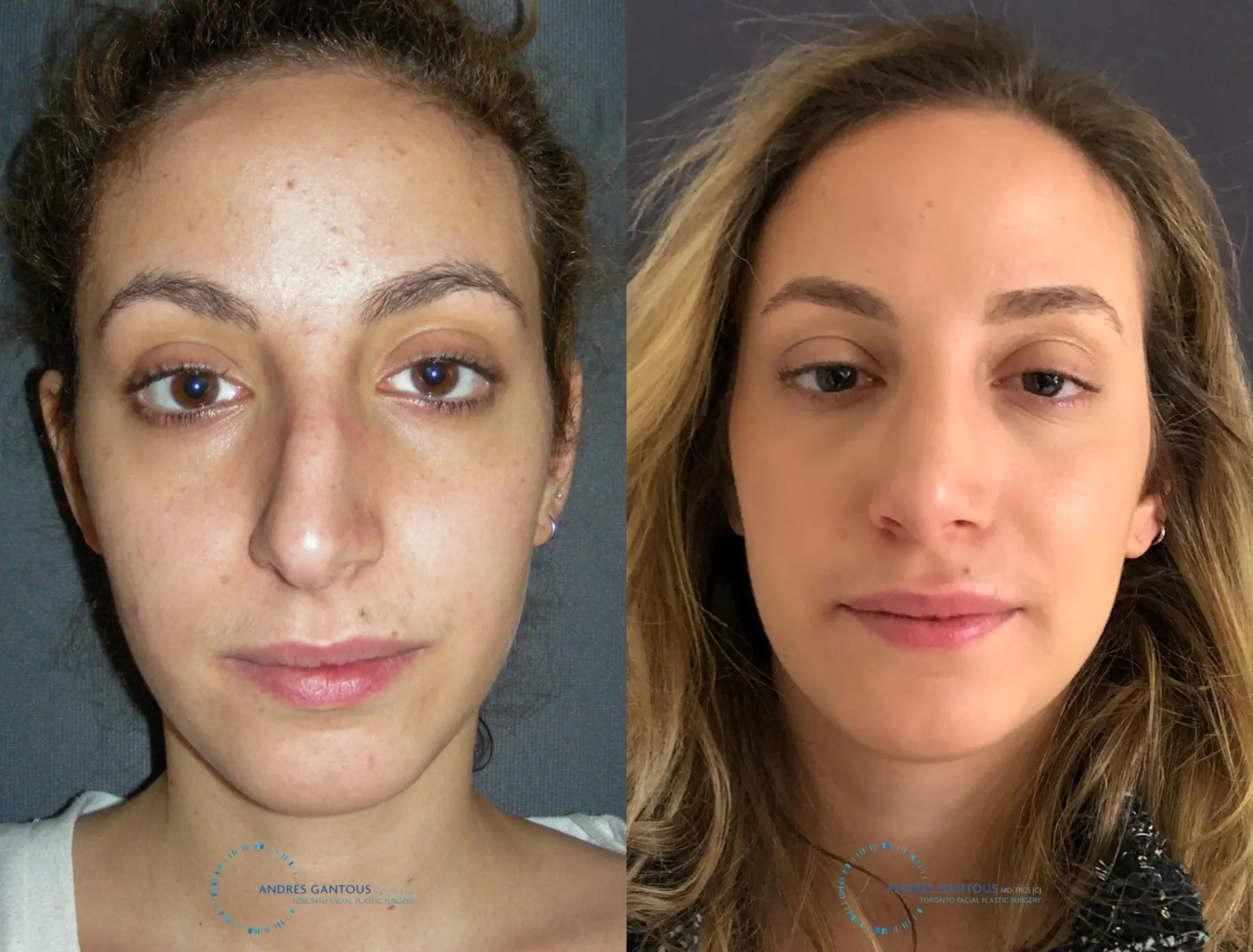 Rhinoplasty: Patient 72 - Before and After 1