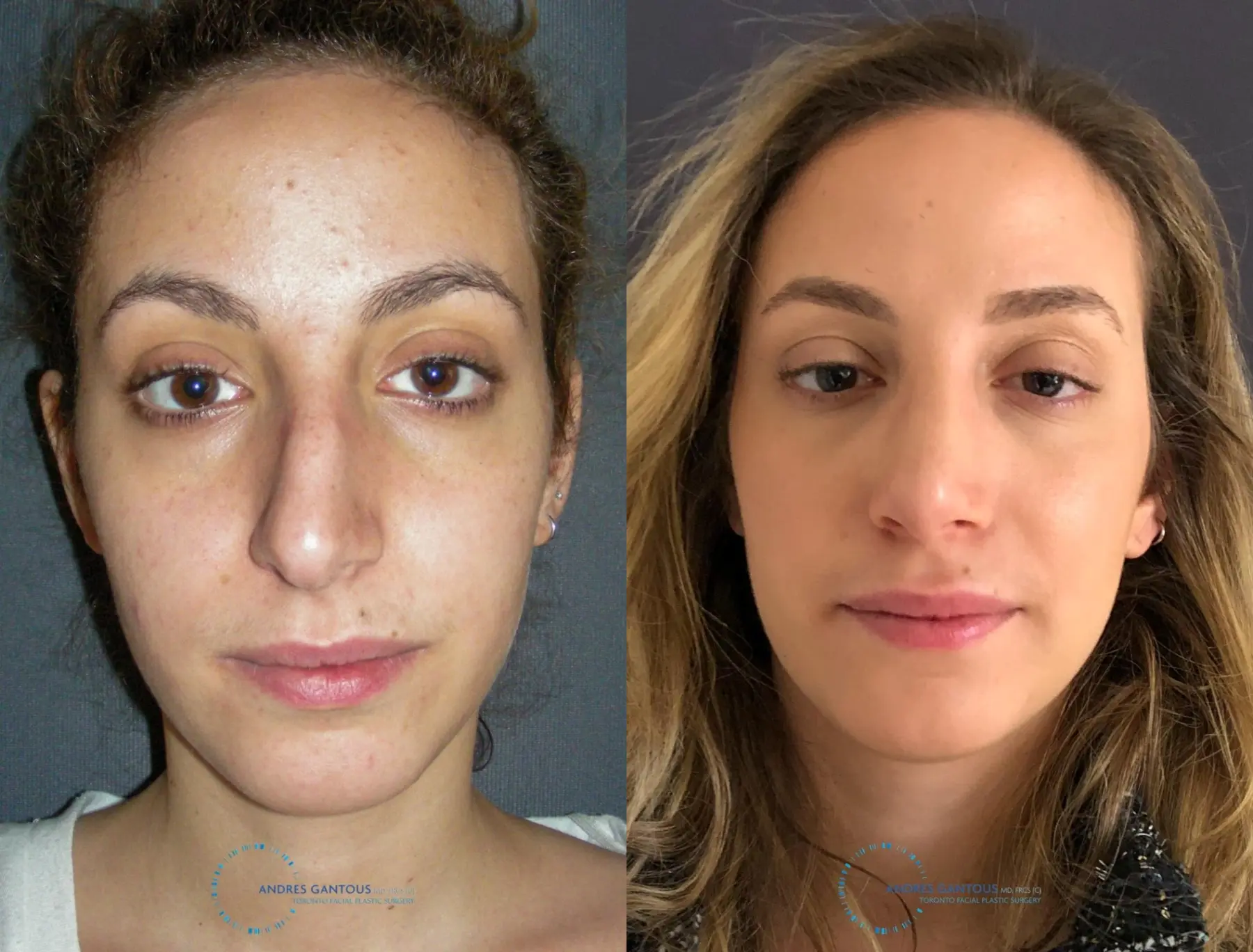 Rhinoplasty: Patient 70 - Before and After  
