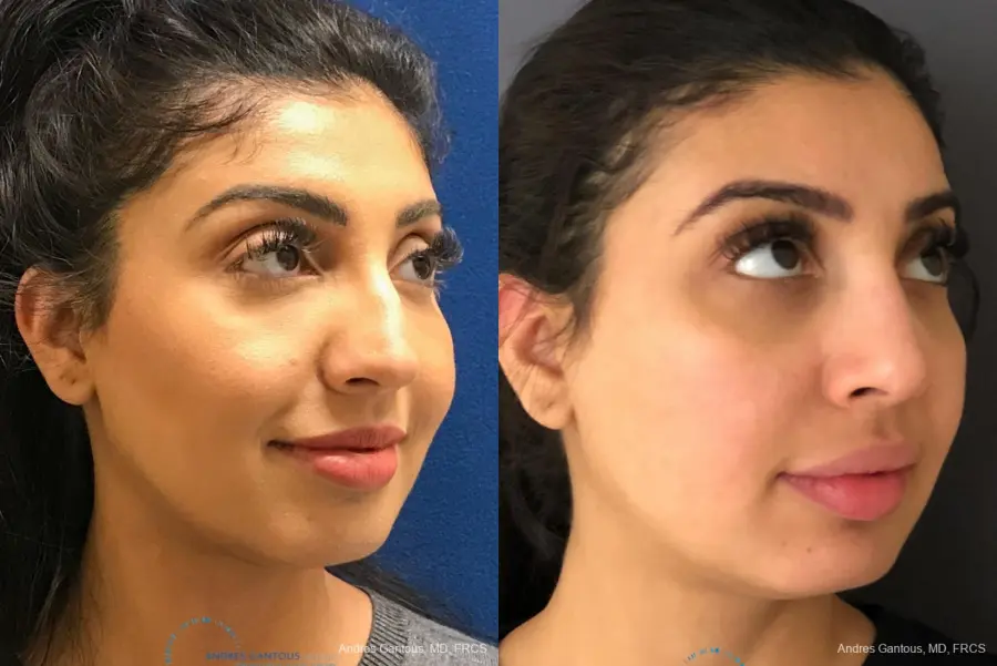 Rhinoplasty: Patient 75 - Before and After 3