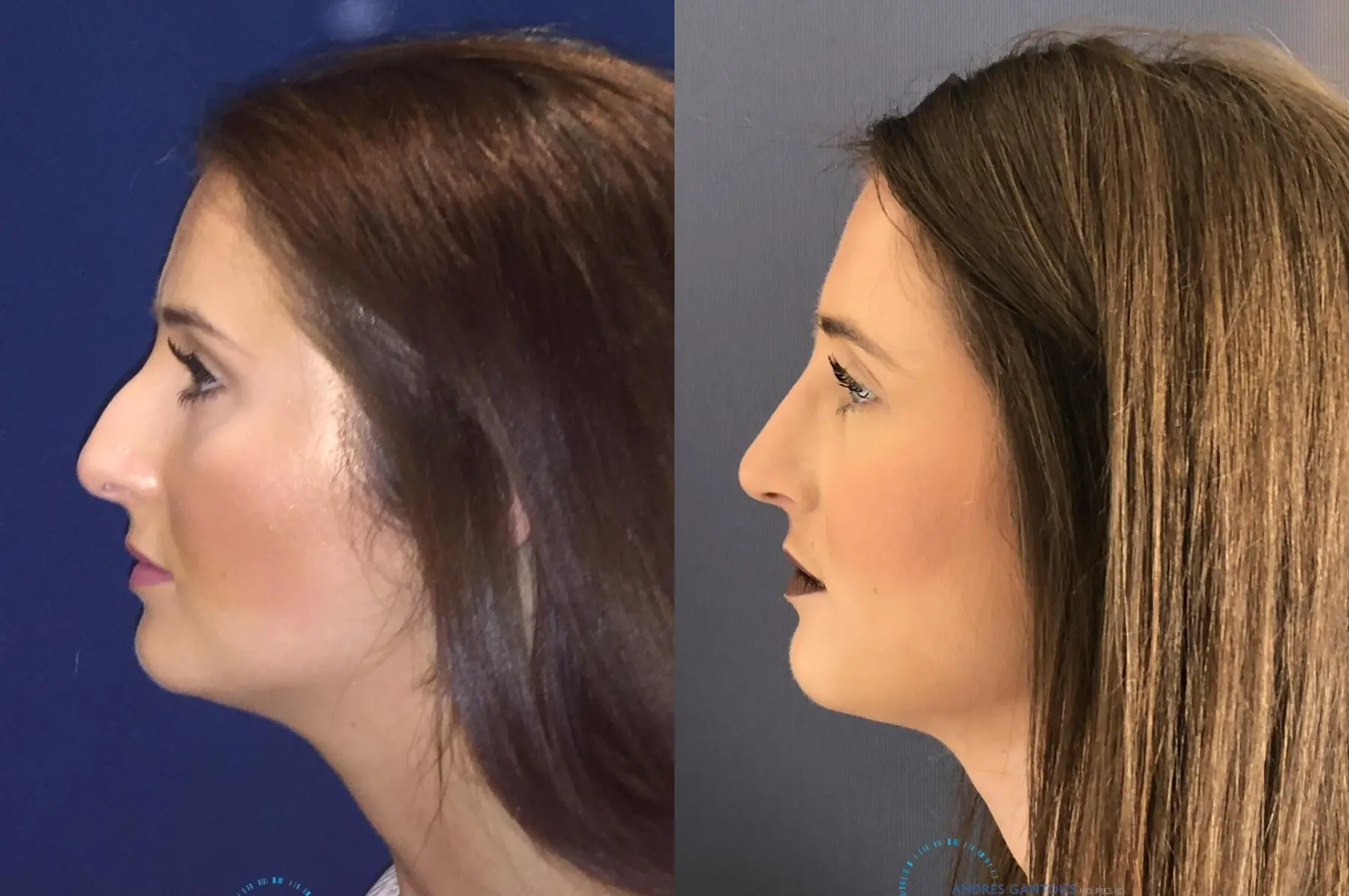 Rhinoplasty: Patient 1 - Before and After 5