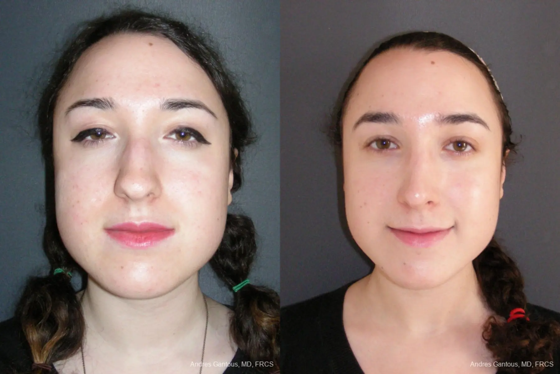 Rhinoplasty: Patient 57 - Before and After  