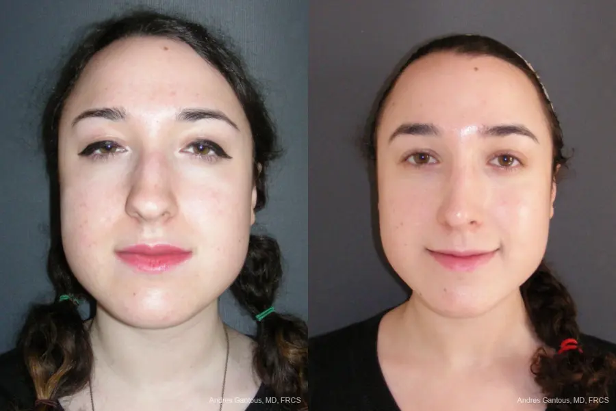 Rhinoplasty: Patient 57 - Before and After 1