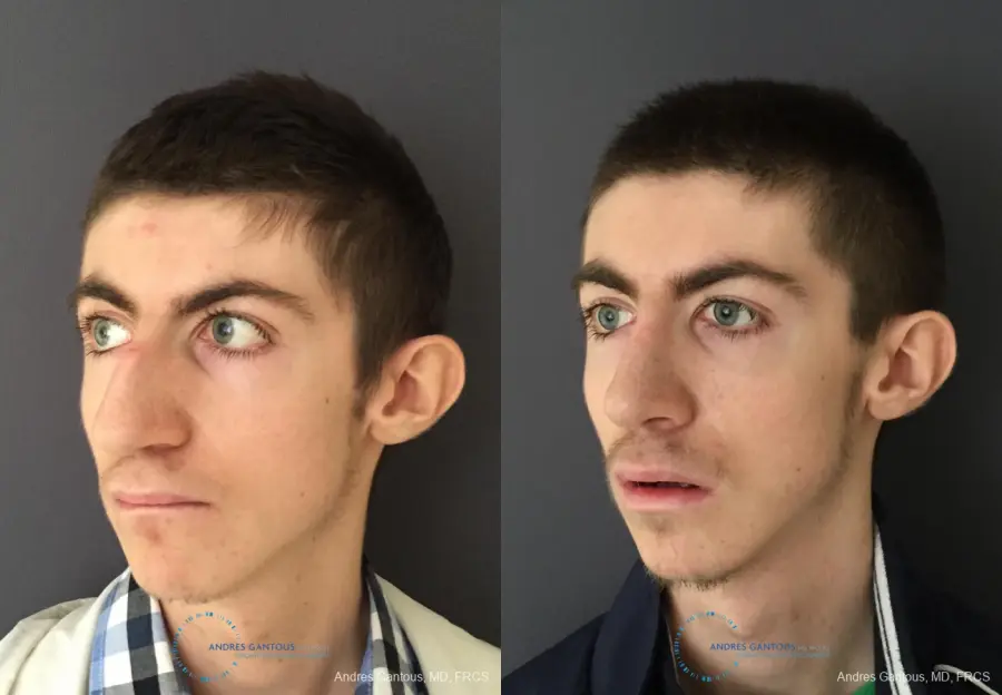 Rhinoplasty: Patient 80 - Before and After 3