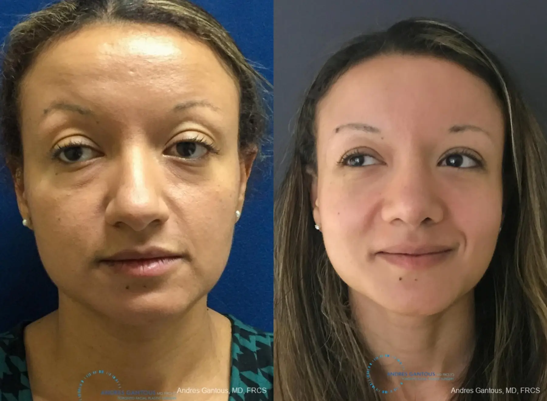 Rhinoplasty: Patient 93 - Before and After 1