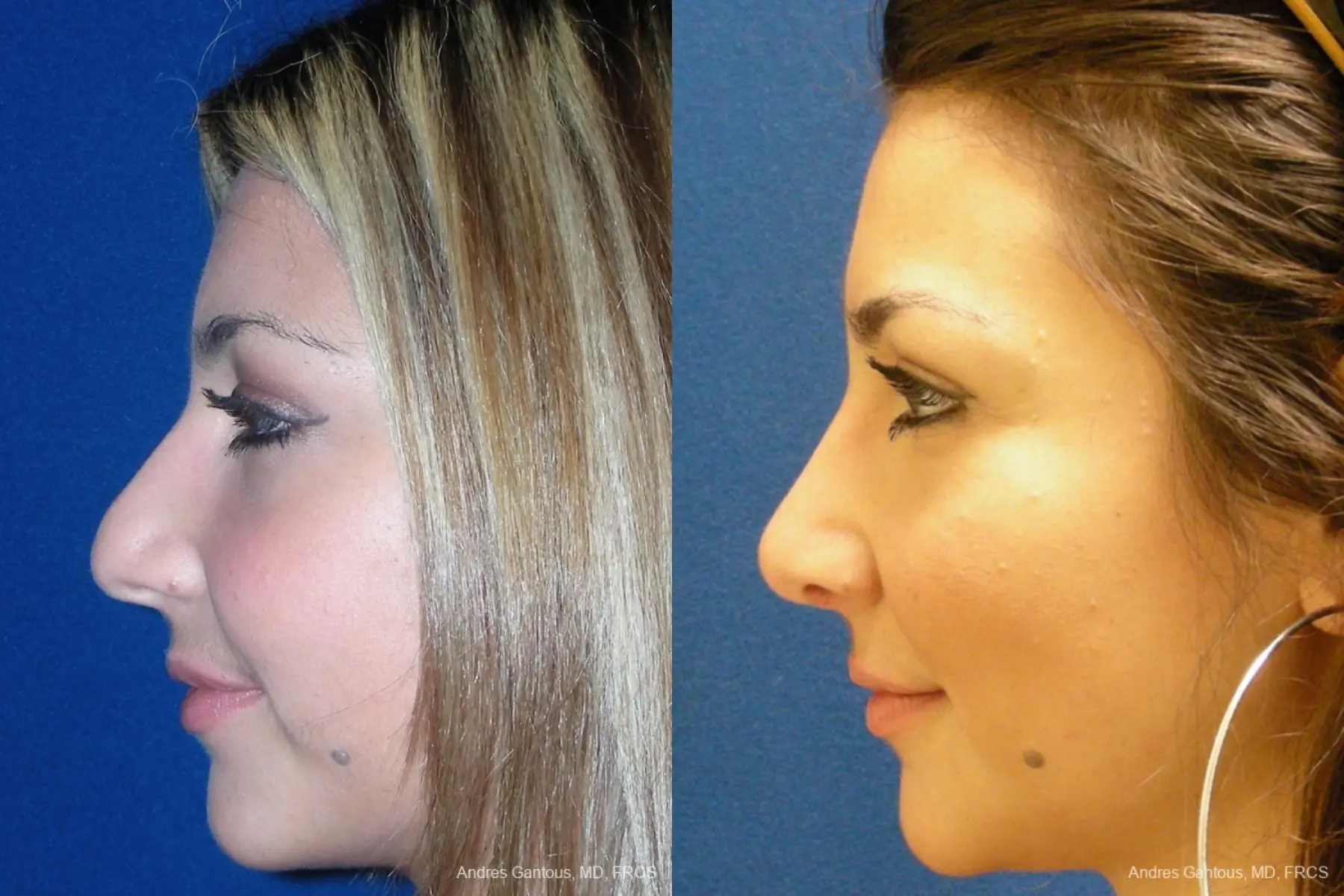 Rhinoplasty: Patient 29 - Before and After 4