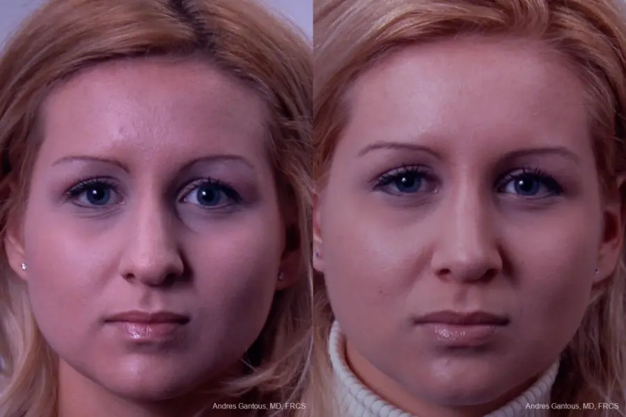 Rhinoplasty: Patient 22 - Before and After 1