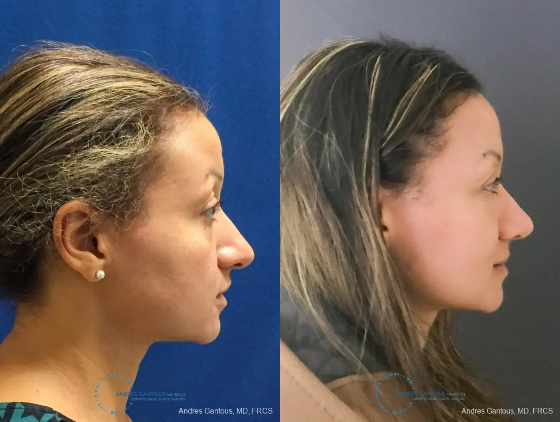 Rhinoplasty: Patient 93 - Before and After 5