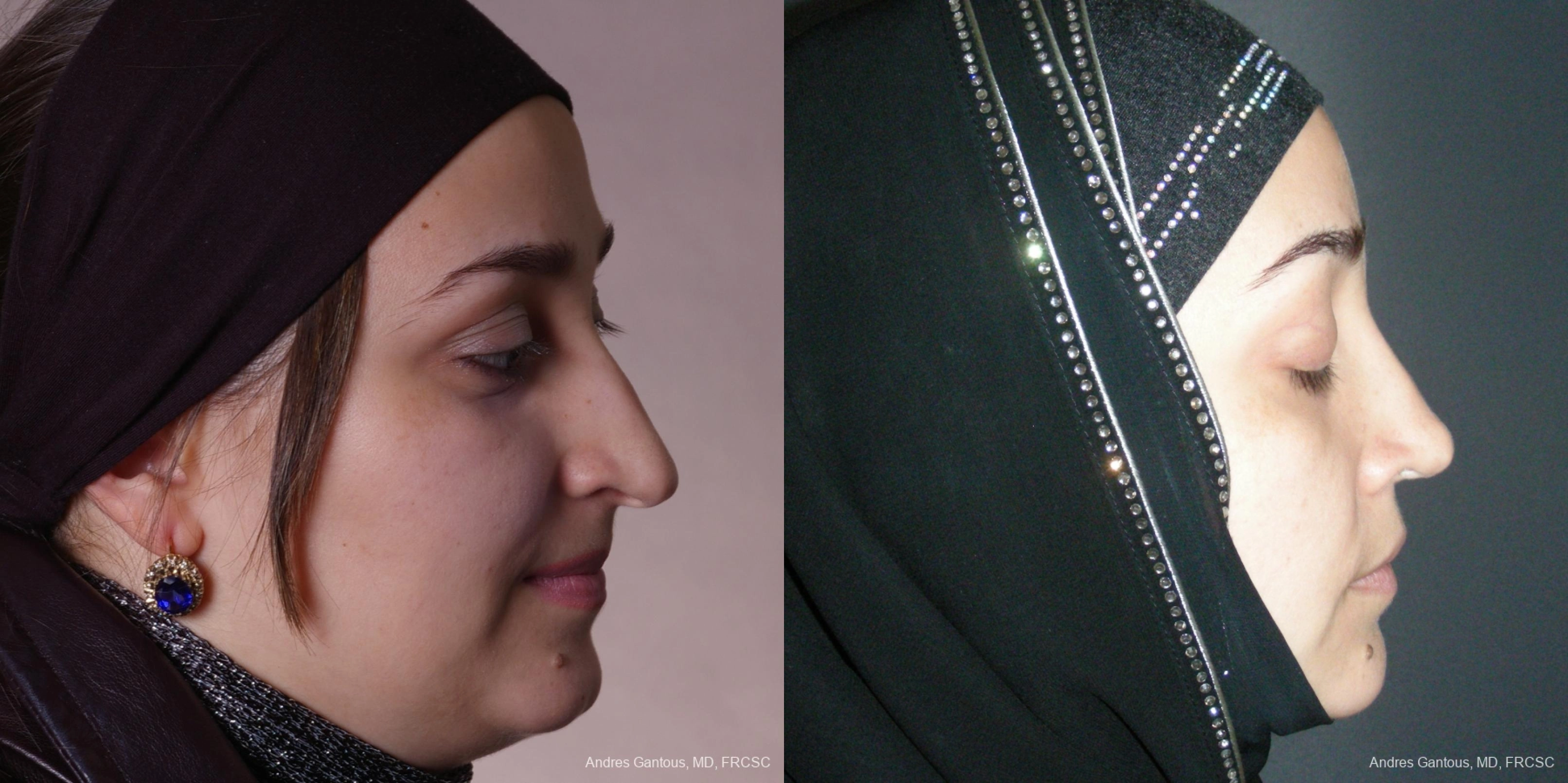 Rhinoplasty - Thumbnail 4