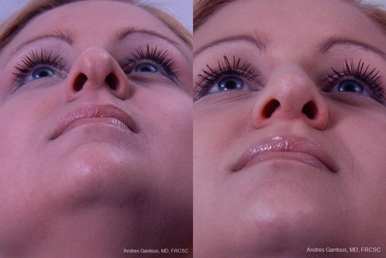 Rhinoplasty - Thumbnail 2