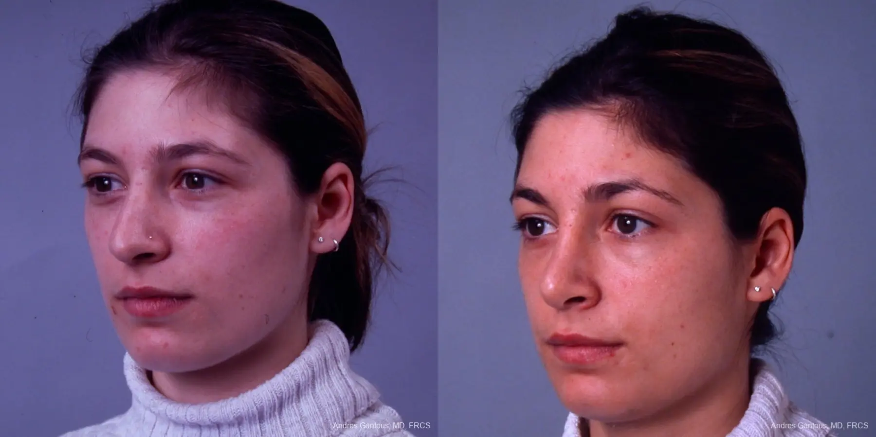 Rhinoplasty: Patient 32 - Before and After 2