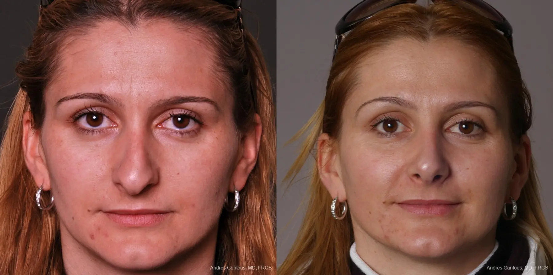 Rhinoplasty: Patient 34 - Before and After  