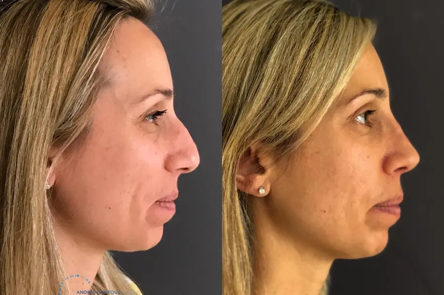 Rhinoplasty: Patient 73 - Before and After 4