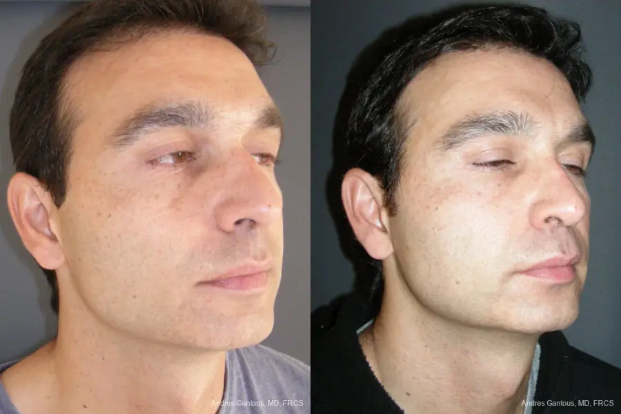 Rhinoplasty: Patient 43 - Before and After 2