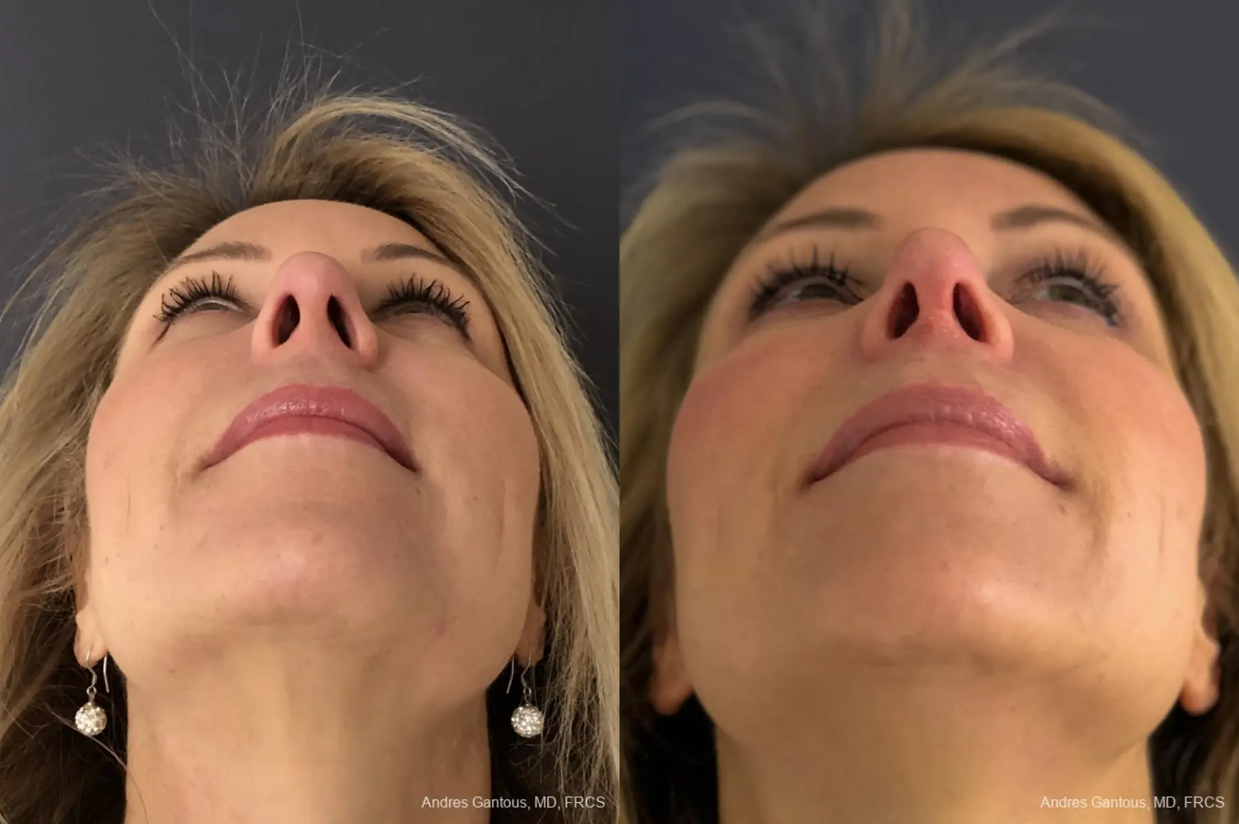 Rhinoplasty: Patient 15 - Before and After 2