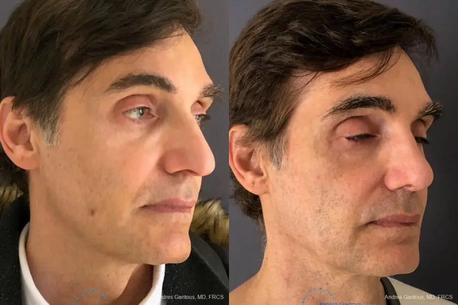 Rhinoplasty: Patient 78 - Before and After 3