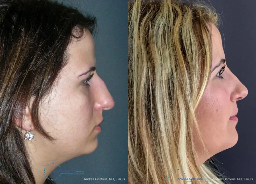 Rhinoplasty: Patient 92 - Before and After 5