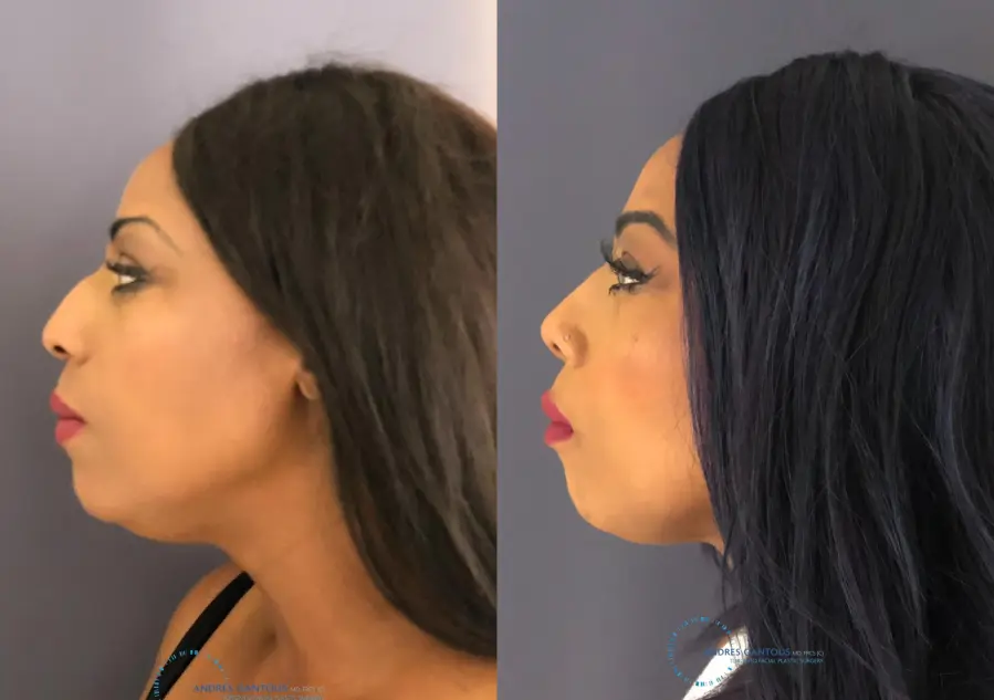 Rhinoplasty: Patient 66 - Before and After 5