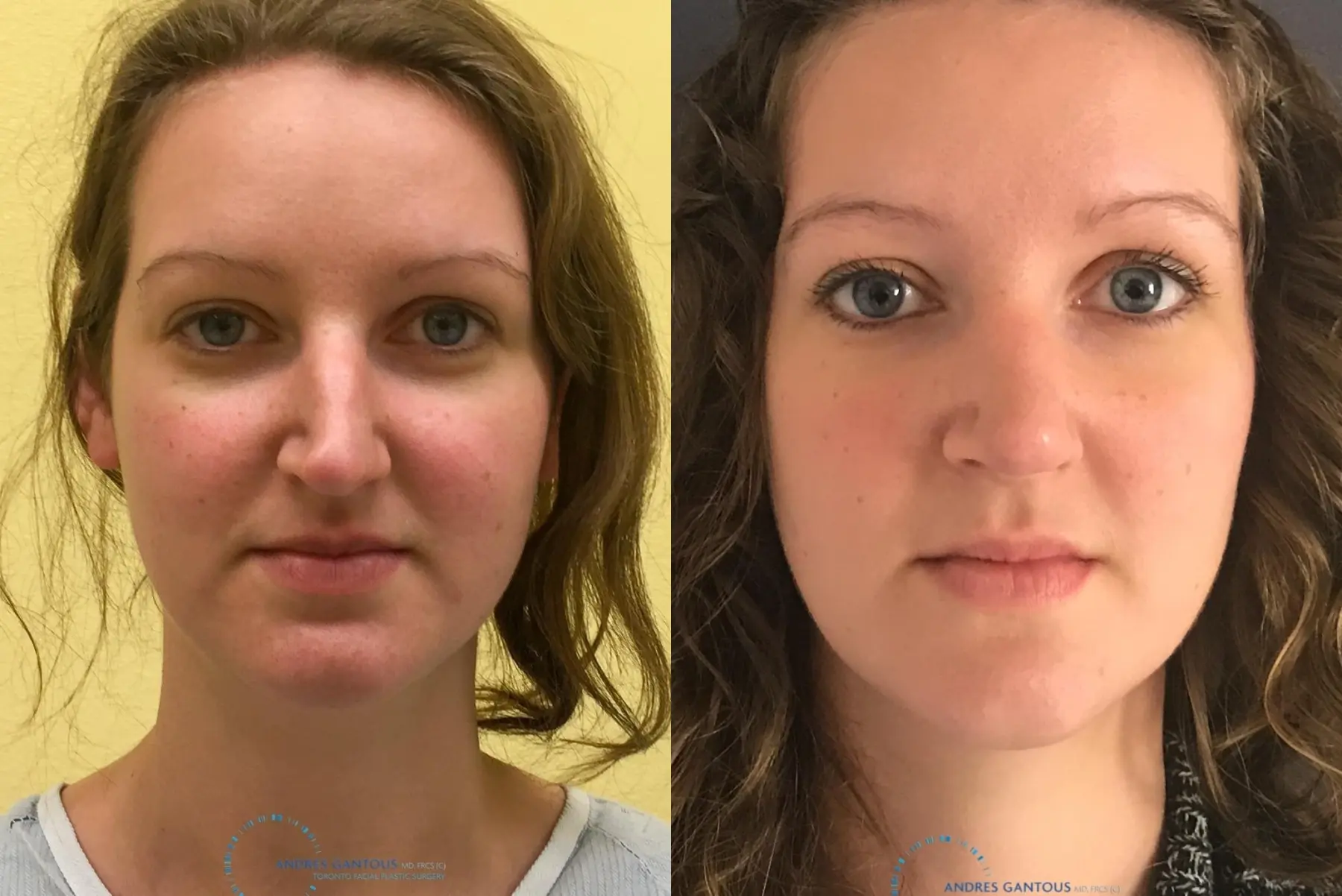 Rhinoplasty: Patient 62 - Before and After  