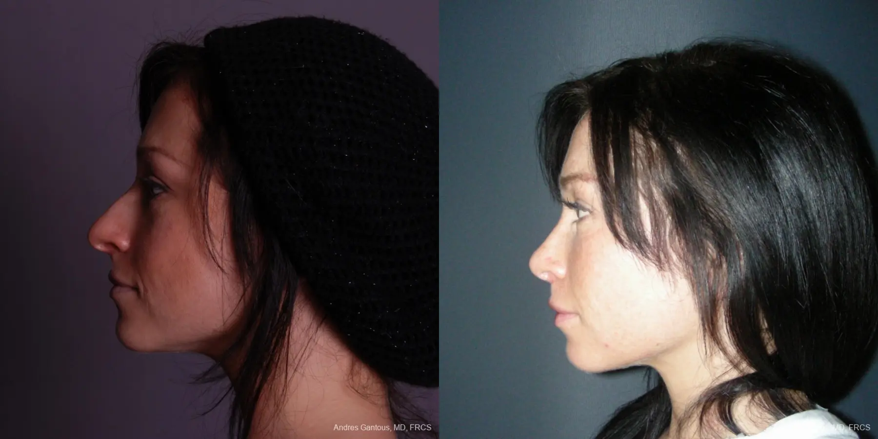 Rhinoplasty: Patient 46 - Before and After 5