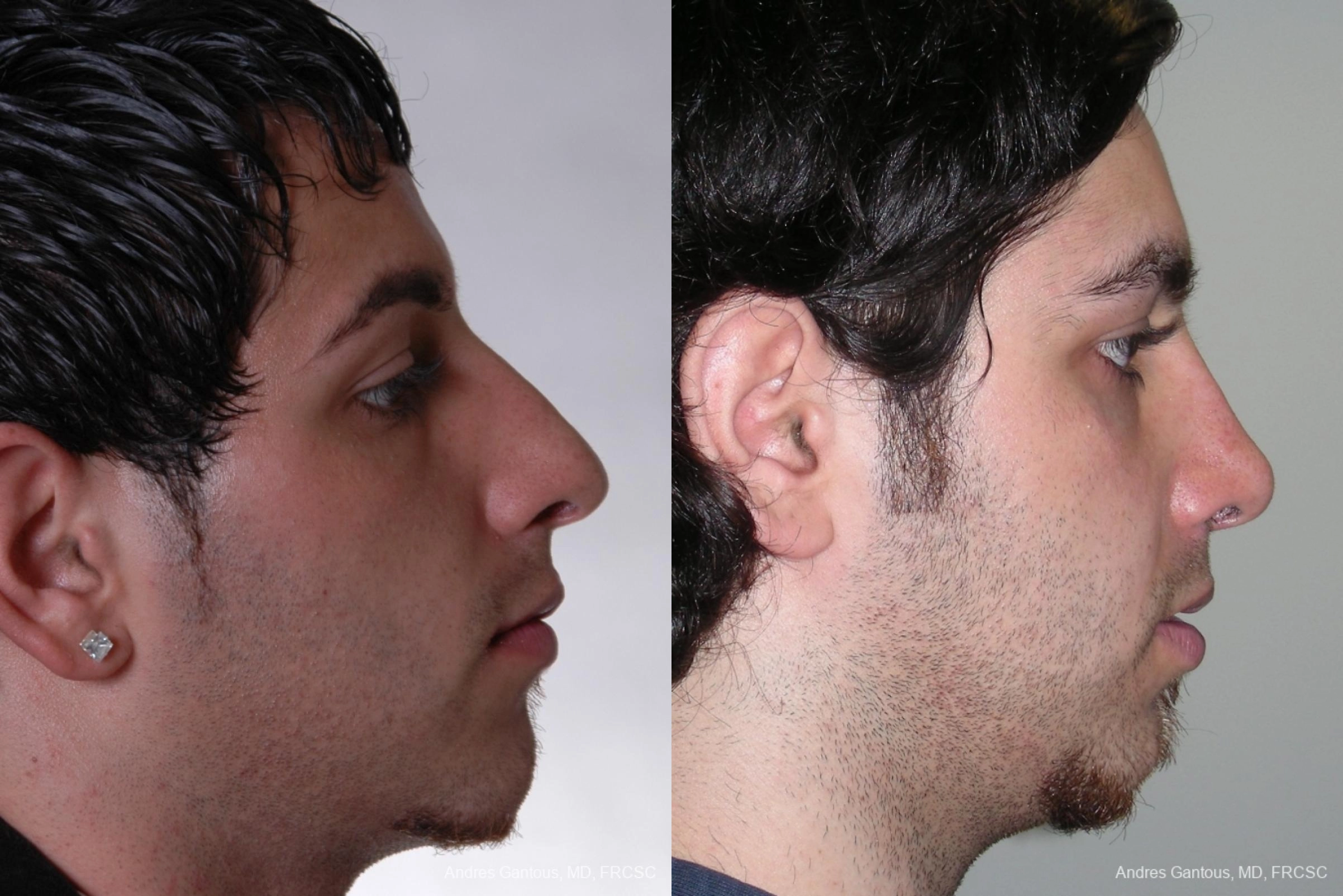 Rhinoplasty - Thumbnail 3