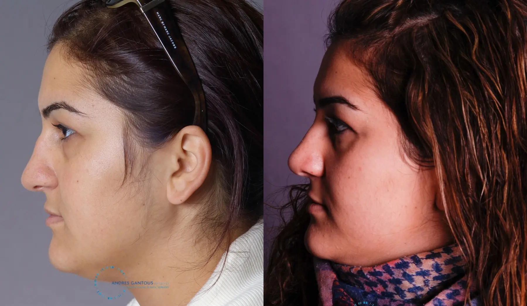 Rhinoplasty: Patient 67 - Before and After 5