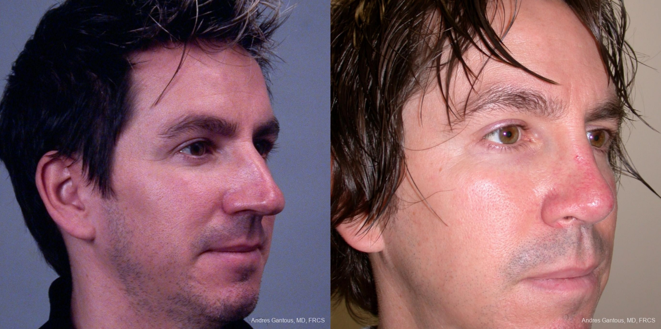 Rhinoplasty - Thumbnail 3