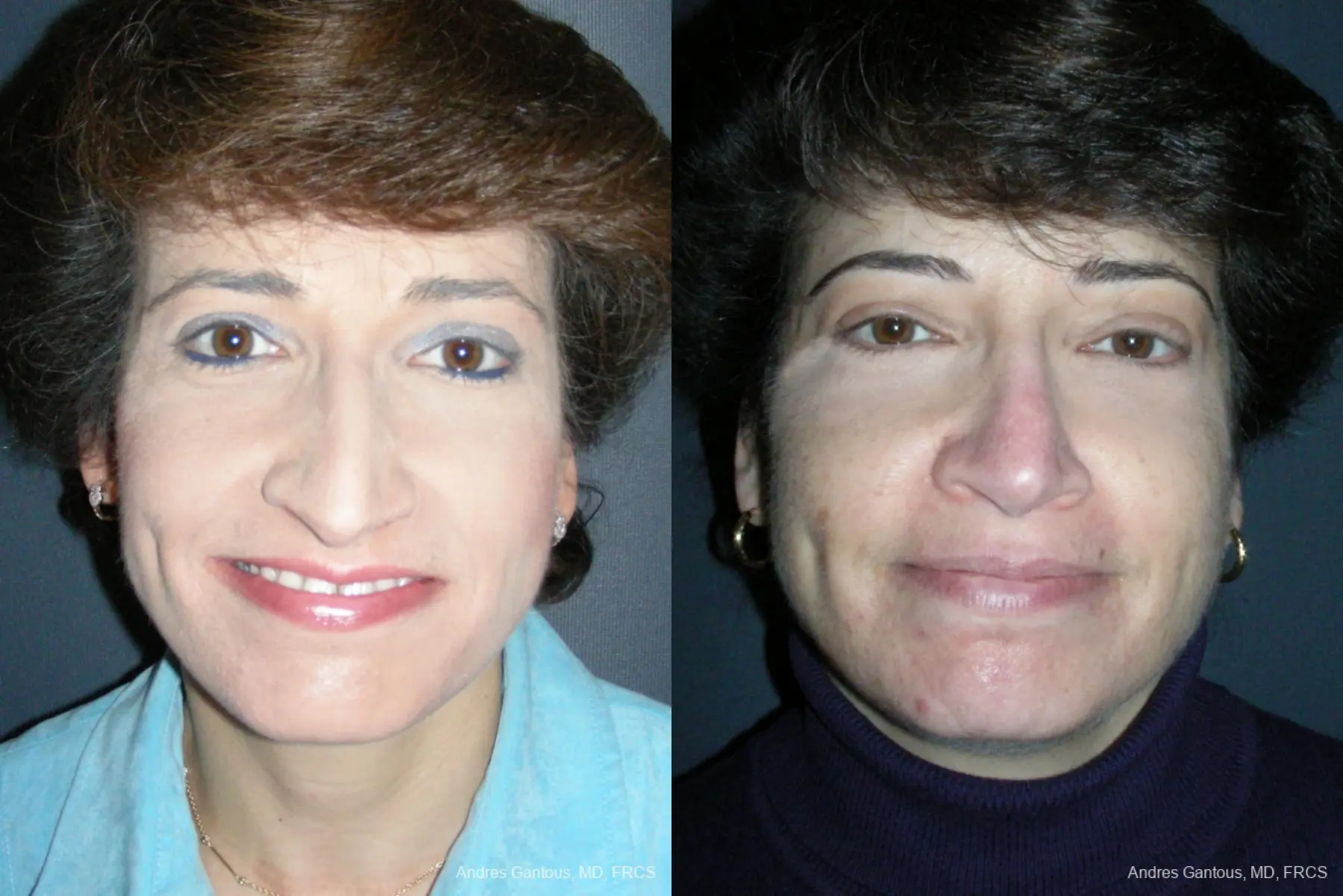 Rhinoplasty: Patient 49 - Before and After  