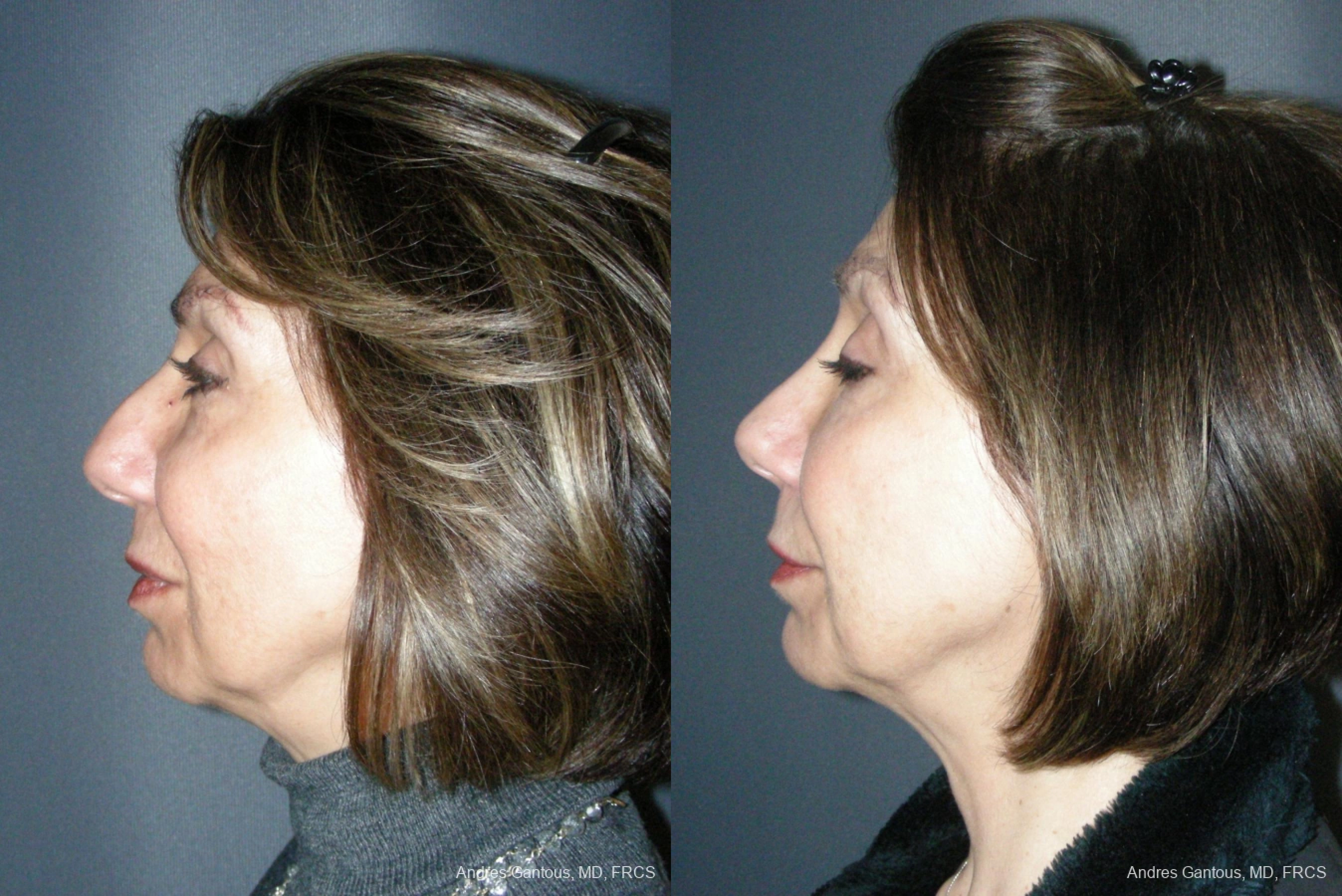 Rhinoplasty - Thumbnail 3