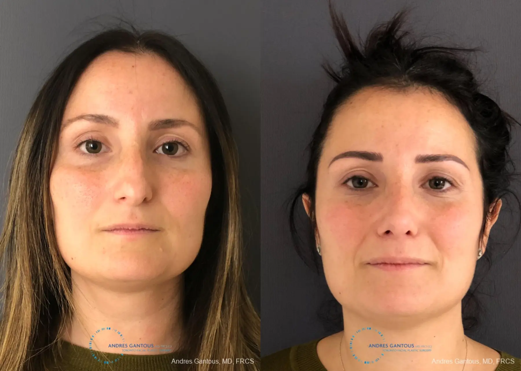 Rhinoplasty: Patient 2 - Before and After  