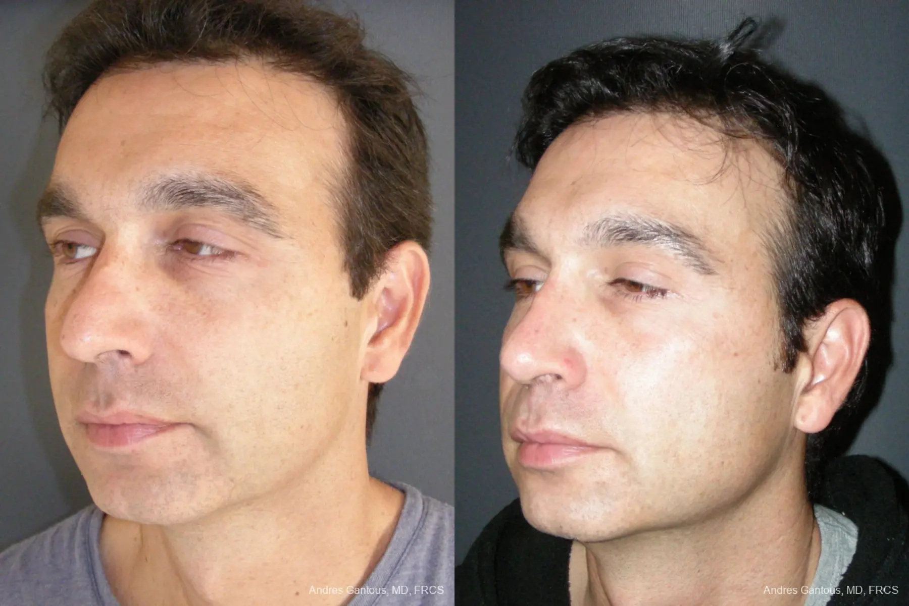 Rhinoplasty: Patient 43 - Before and After 4