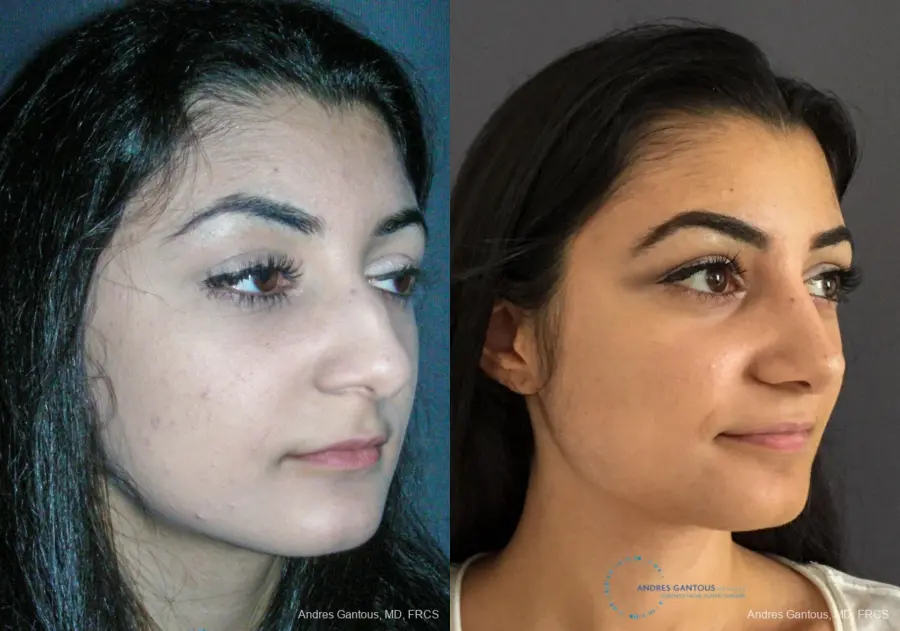Rhinoplasty: Patient 87 - Before and After 3