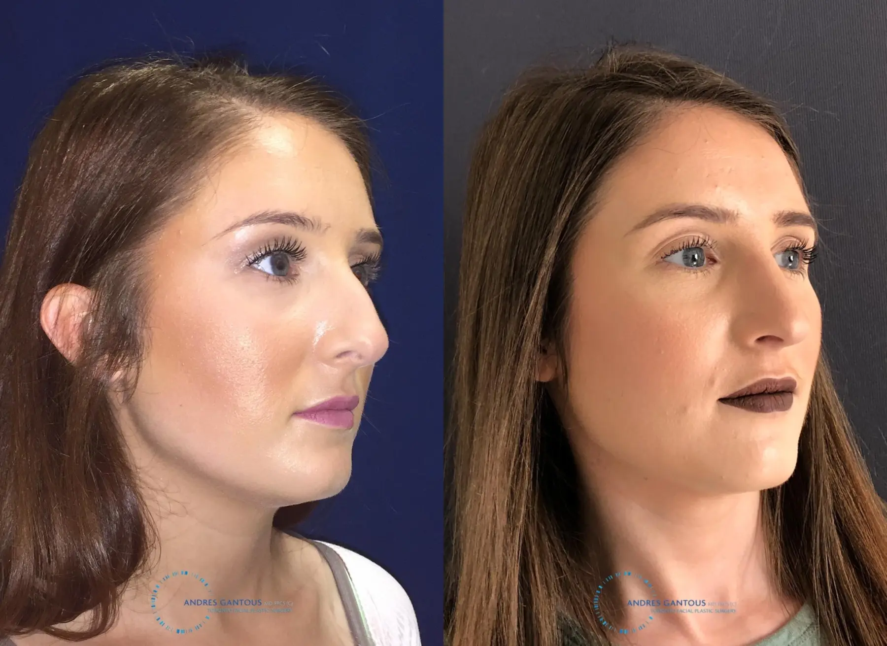 Rhinoplasty: Patient 1 - Before and After 4