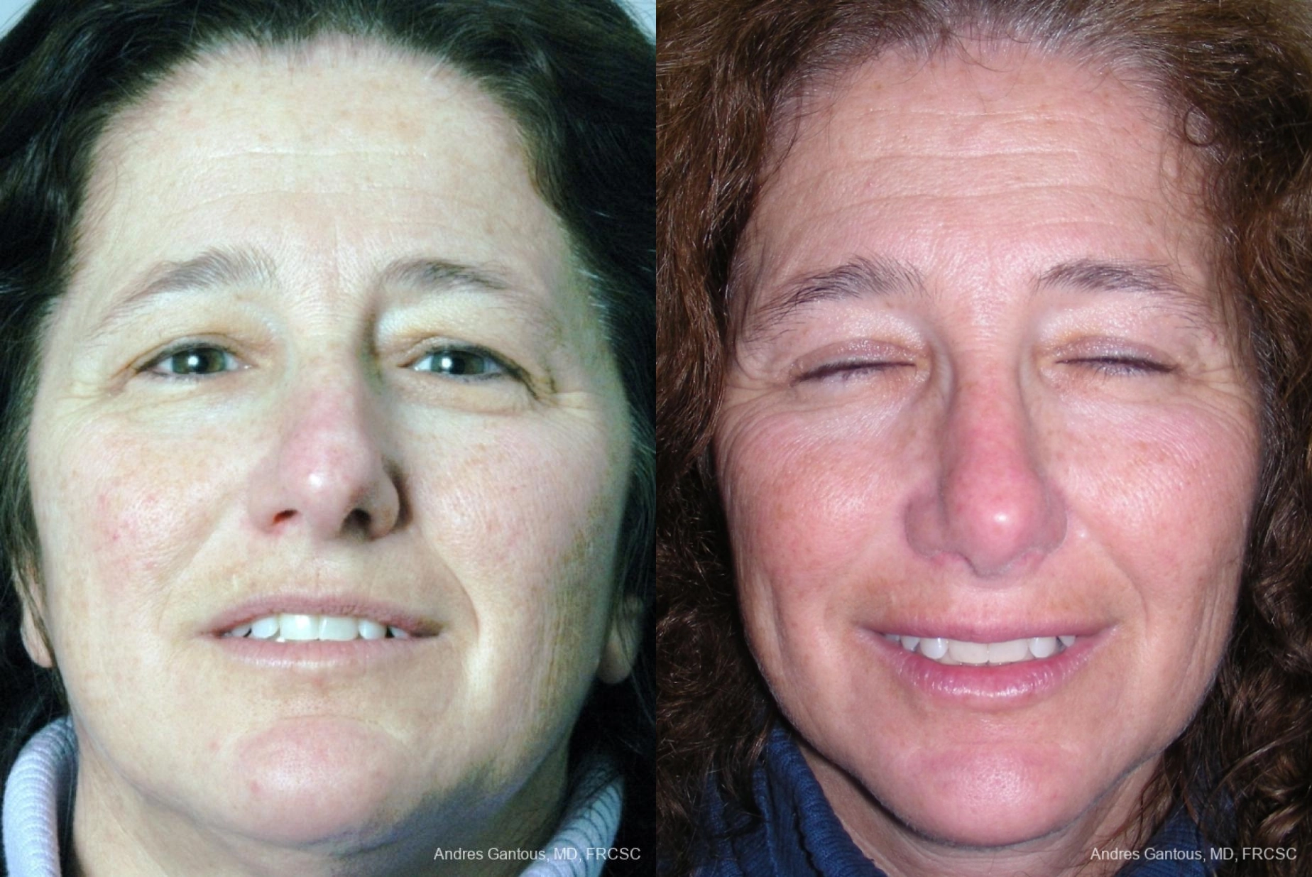 Nose Procedures - Case 11592