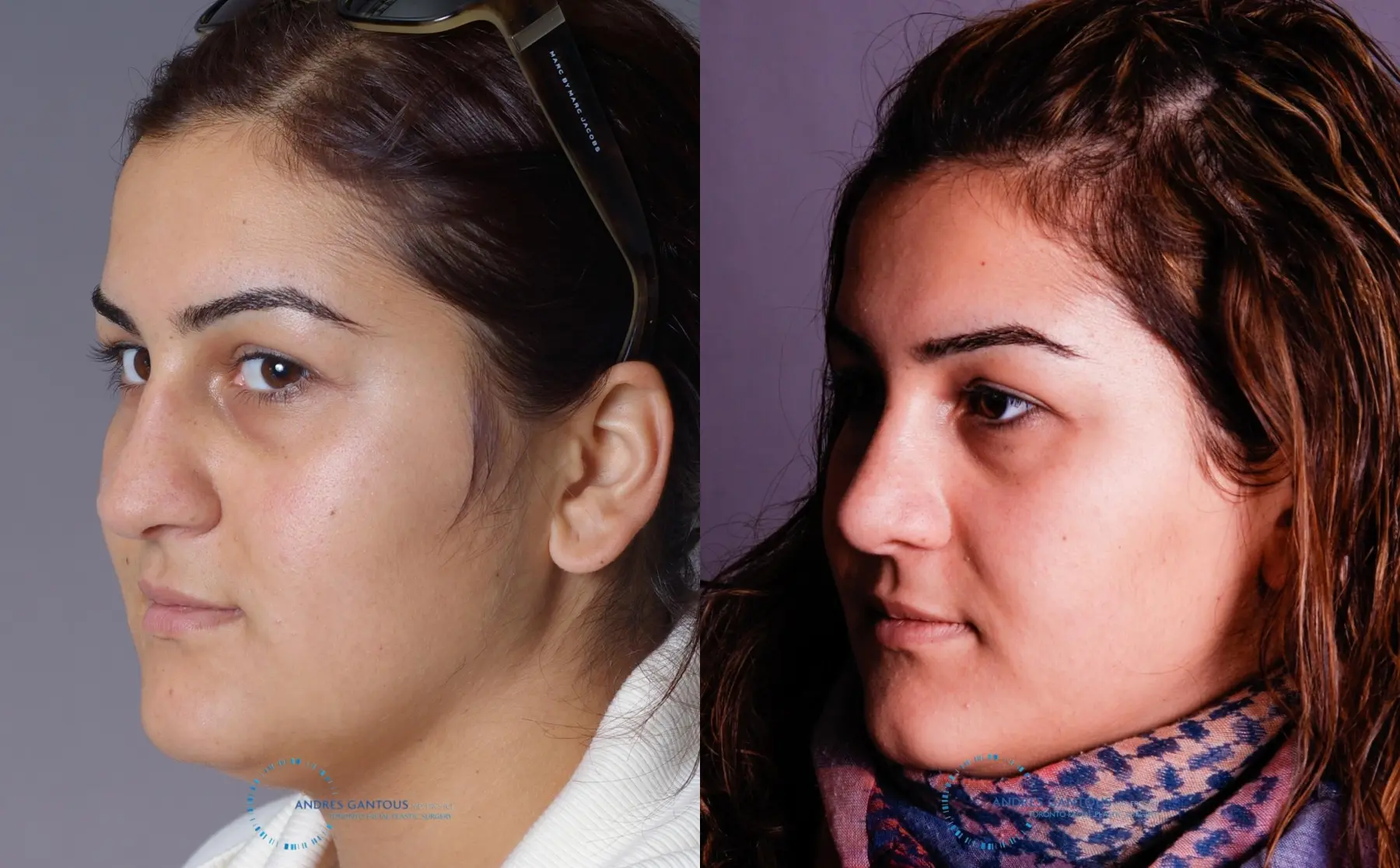 Rhinoplasty: Patient 67 - Before and After 3