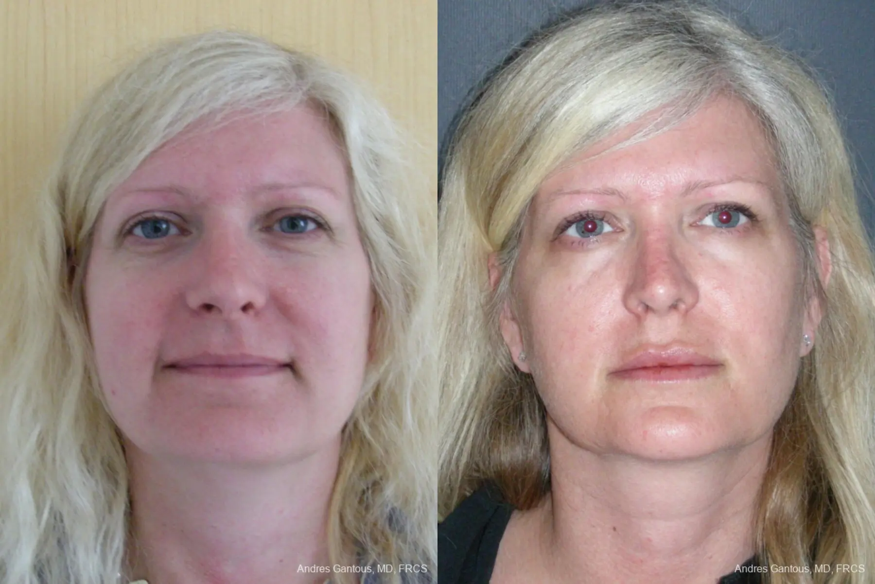 Rhinoplasty: Patient 44 - Before and After  