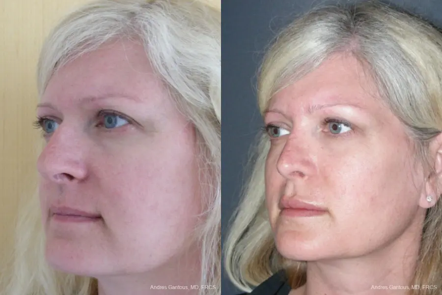 Rhinoplasty: Patient 44 - Before and After 4