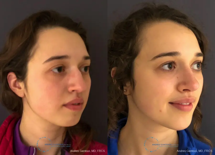 Rhinoplasty: Patient 4 - Before and After 3