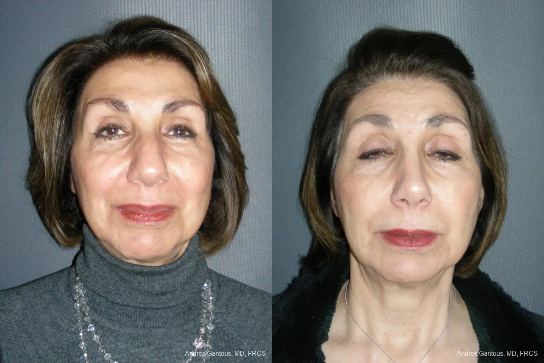 Rhinoplasty: Patient 53 - Before and After  