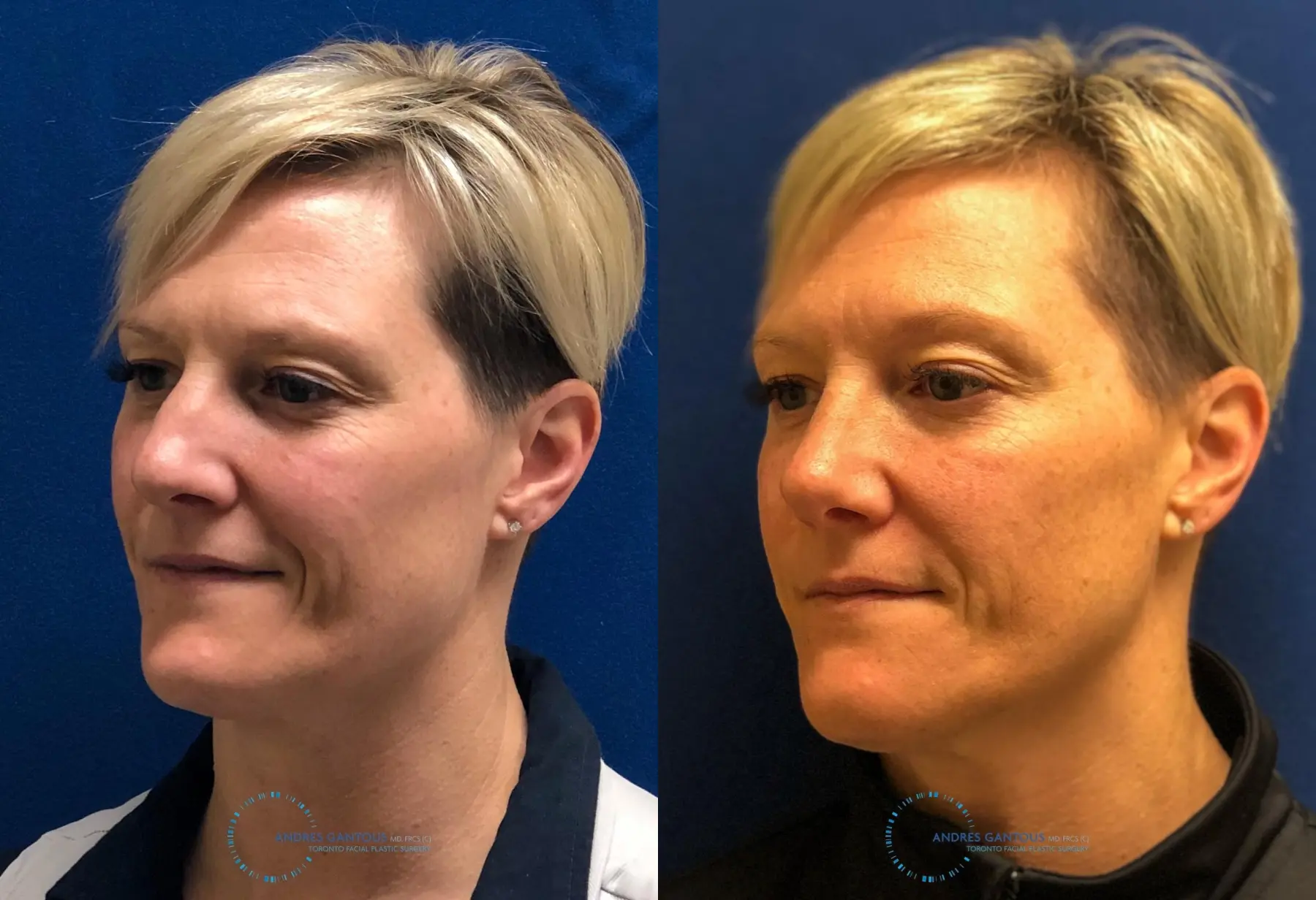 Rhinoplasty: Patient 68 - Before and After 4