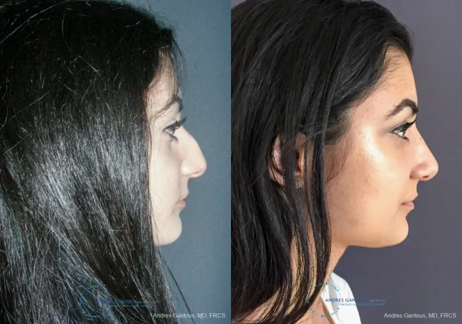 Rhinoplasty: Patient 87 - Before and After 5