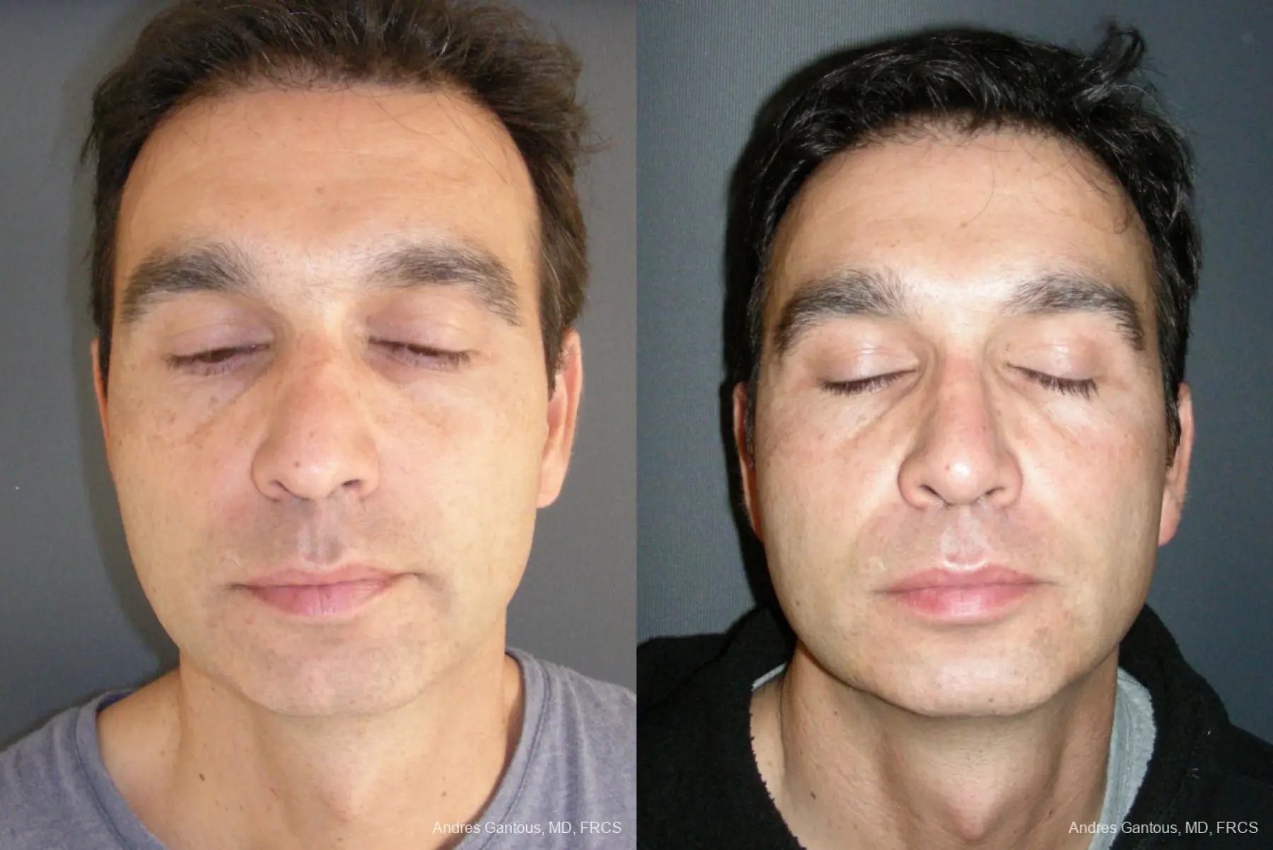 Rhinoplasty: Patient 43 - Before and After  