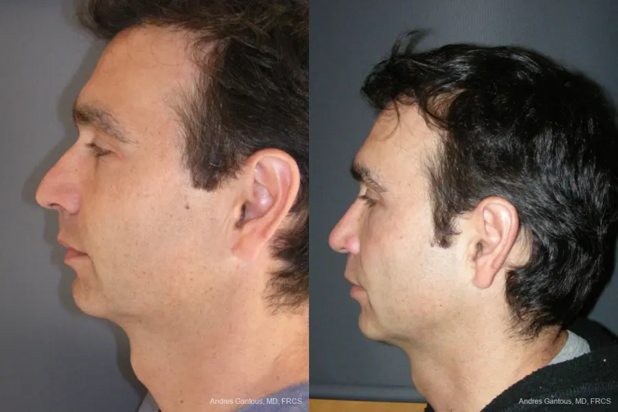 Rhinoplasty: Patient 43 - Before and After 5