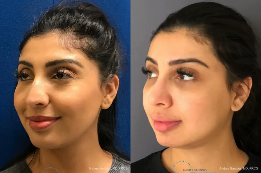 Rhinoplasty: Patient 75 - Before and After 4
