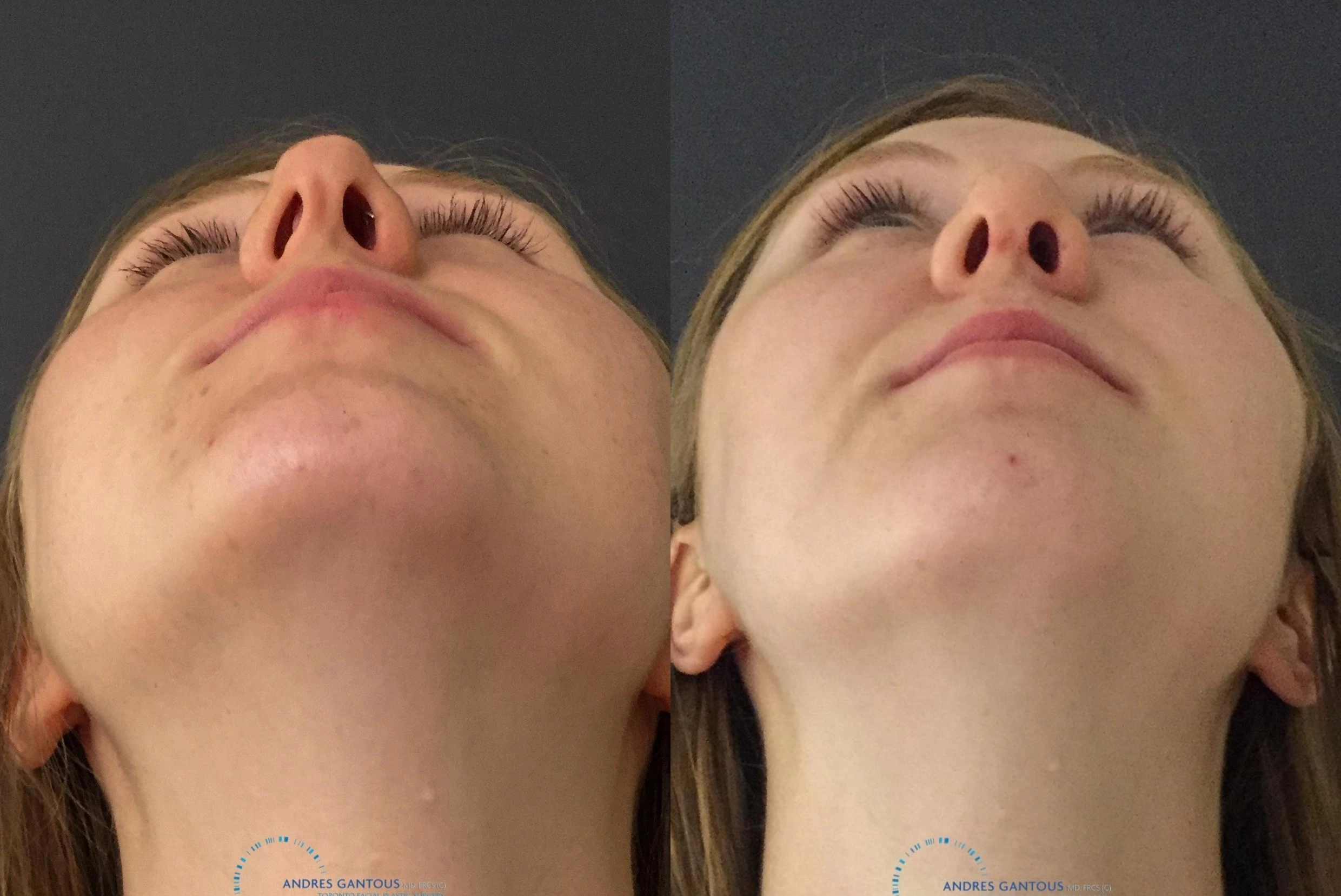 Rhinoplasty - Thumbnail 2