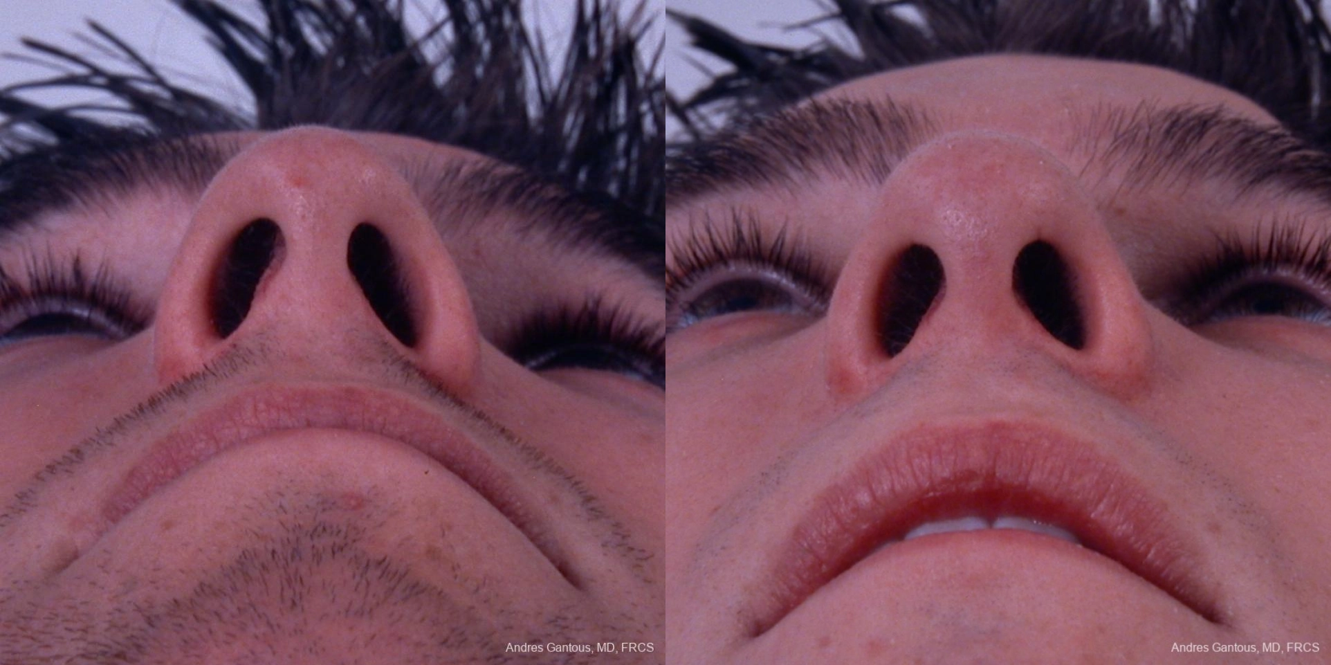 Rhinoplasty - Thumbnail 4